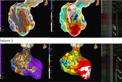 Virtual hearts of two patients built by Trayanova’s team at Johns Hopkins University.